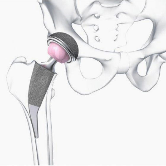 3D/Film - Animation - Visualisierung - Beger Design - METHA - Hip Prosthesis - Aesculap